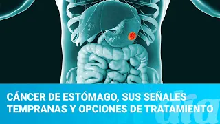 Cáncer de estómago, sus señales tempranas y opciones de tratamiento