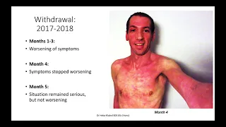 TSW (Topical Steroid Withdrawal) Case Example: Santiago Aufranc