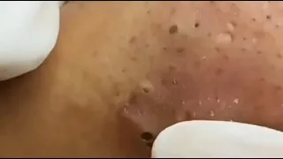 WOOW !! BLACKHEADS REMOVAL FROM THE NOSE 😨#2 #relaxing  #blackheads