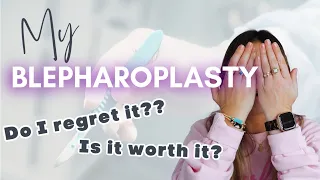 MY BLEPHAROPLASTY STORY 🧑‍⚕️💉 | IS IT WORTH IT? | ANY REGRETS?