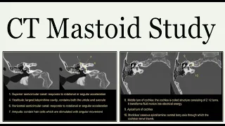 ct mastoid study