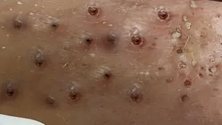 Loan Nguyen Acne Treatment