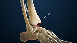 Arthrodesis | Arthroscopic Ankle Fusion Surgery | Nucleus Health