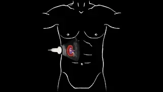 POCUS -  Basic Renal Ultrasound