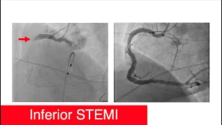 Inferior STEMI, Don't Give Nitro, Cath Images[Part 5]