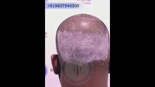 Donor Area Cleaning & Dressing - 2 Days After Hair Transplant #short | Hairfree & Hairgrow Clinic