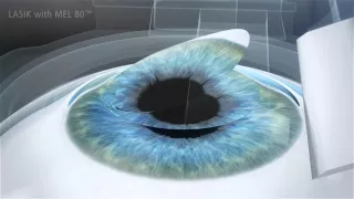 Laser Surgery - Zeiss animation of Refractive Laser procedure called LASIK (no audio presentation)