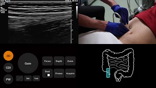 Ultrasound Tutorial: Appendix/Appendicitis | Radiology Nation