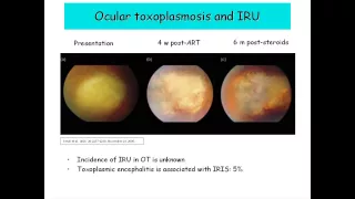 Infectious Retinopathies by Carlos Subauste, MD