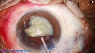 Rhexis in anterior Capsular Fibrosis, Direct Chop, Hydroimplantation: Pradip Mohanta, 14 May, 2024