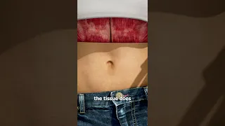 What Causes An Outie Belly Button? 🤔