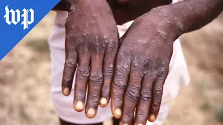 What to know about monkeypox