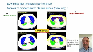 ИВЛ при рестриктивной патологии легких  2020  Сатишур О.Е.