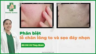 7 dấu hiệu giúp phân biệt sẹo đáy nhọn và lỗ chân lông to