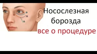 Как убрать мешки и синяки под глазами за один день. Коррекция носослезной борозды.