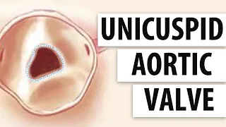 Unicuspid Aortic Valves: Top 5 Facts Patients Should Know