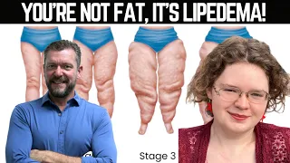 It's NOT Obesity, it's Lipedema [with Siobhan Huggins]