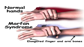 Marfan Syndrome