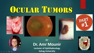 Ocular Tumors Part 1