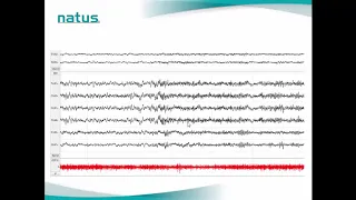 Natus PSG Webinar: Case Study Scoring Sleep Stages & Limb Movements