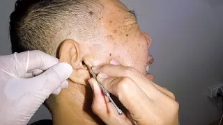 Removing Man's HUGE Black Earwax| Can He Survive?