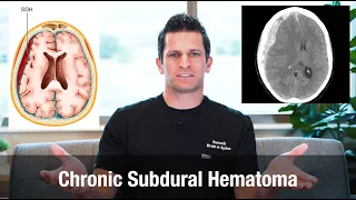 what is a Chronic Subdural Hematoma