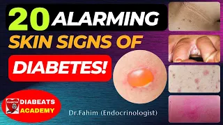 20 ALARMING Diabetes Skin Signs and Symptoms with PHOTOS and Control Tips! (YOU MUST NOT IGNORE)