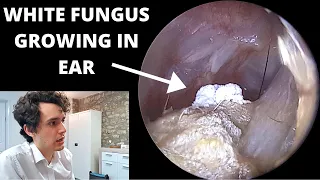 White Fur Growing in Ear Removed With Suction (Otomycosis Fungal Infection)