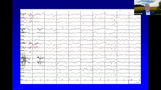 Grand Rounds. The EEG of Toxic-Metabolic Encephalopathy. Dr. Peter Kaplan. 10/1/2021