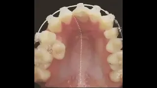как работают брекеты для зубов