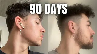 How To GROW A BEARD In 90 Days Using MINOXIDIL & DERMA ROLLER