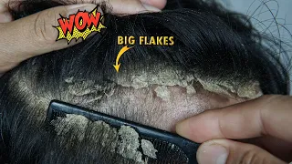 Combing Out Dandruff Flakes Satisfying #1251