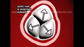 Aortic Regurgitation (insufficiency) in Aortic Dissection by Cal Shipley, M.D.