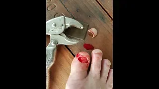 Big Toenail Removal with Vice Grips...