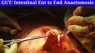 Intestinal anastomosis surgery