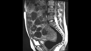 Large fibroid uterus