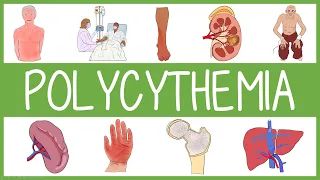 Polycythemia: Clinical Features, Management and Mnemonics