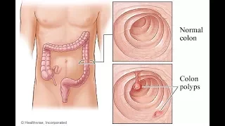 What is a Colon Polyp? | Los Angeles Colonoscopy|Removal of a Colon Polyp