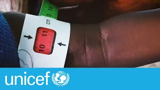 A simple tool to detect severe malnutrition: the MUAC tape