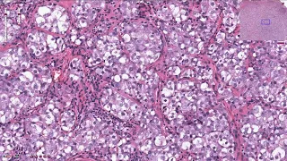 Seminoma, Testis - Histopathology