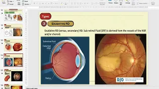 Retinal Detachment