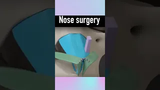 Nose surgery 3d animated video