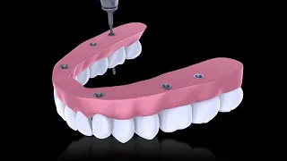 Introducing the Smart Denture Conversions System