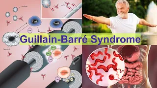 Guillain-Barre syndrome