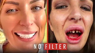 The Horrible Truth Behind My 'Turkey Teeth' | No Filter | @LADbible