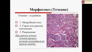 Крупозная пневмония