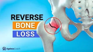 Top 4 Natural Ways To Fix Osteoporosis (Reverse Bone Loss!)