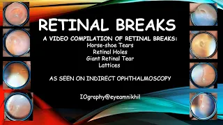 Retinal breaks as seen on indirect ophthalmoscopy : a video compilation