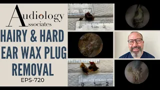 HAIRY & HARD EAR WAX PLUG REMOVAL - EP720