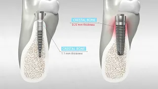 IMPLANTOLOGY - REX PIEZOIMPLANT/REXPANDER presentation